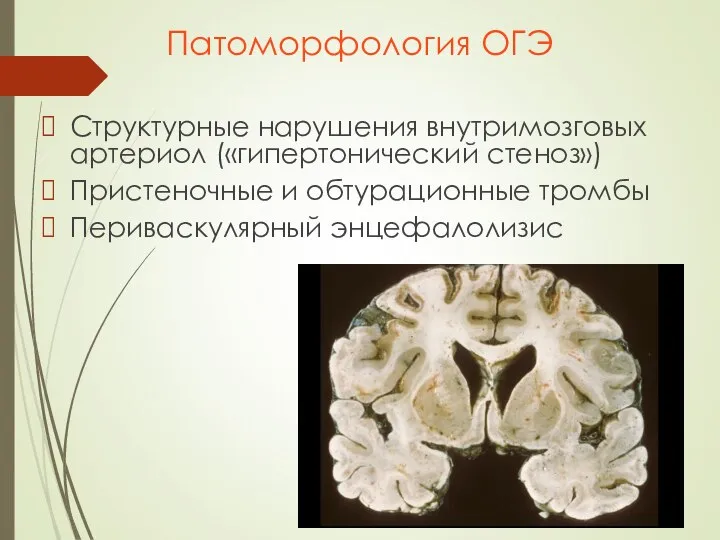 Патоморфология ОГЭ Структурные нарушения внутримозговых артериол («гипертонический стеноз») Пристеночные и обтурационные тромбы Периваскулярный энцефалолизис