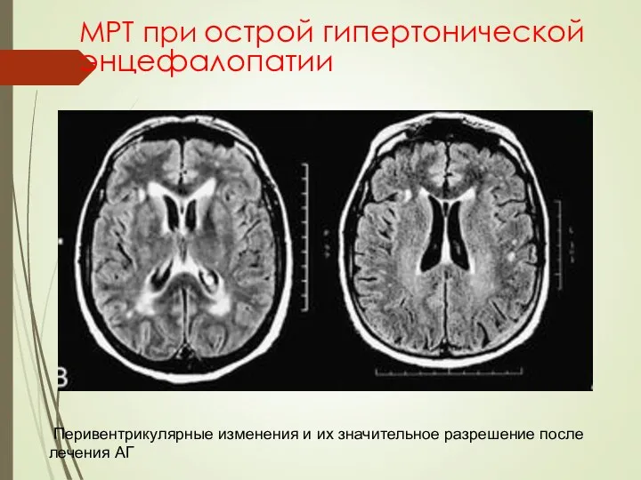 МРТ при острой гипертонической энцефалопатии Перивентрикулярные изменения и их значительное разрешение после лечения АГ