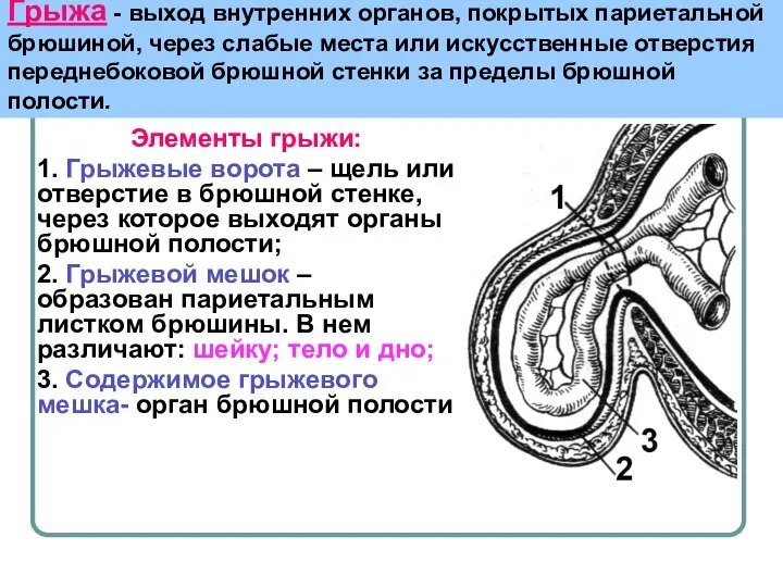 Грыжа - выход внутренних органов, покрытых париетальной брюшиной, через слабые места