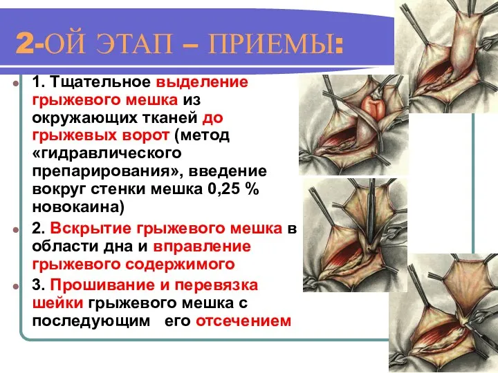 2-ОЙ ЭТАП – ПРИЕМЫ: 1. Тщательное выделение грыжевого мешка из окружающих