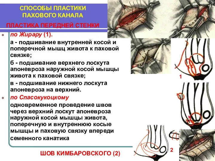 по Жирару (1). а - подшивание внутренней косой и поперечной мышц