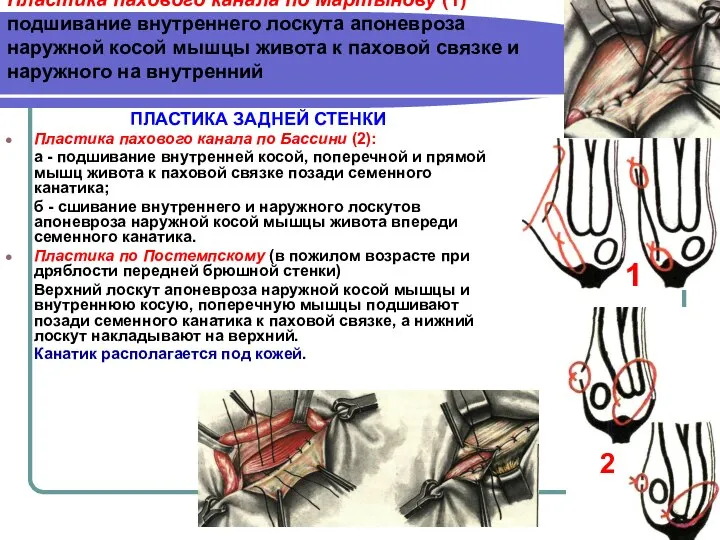 Пластика пахового канала по Мартынову (1) подшивание внутреннего лоскута апоневроза наружной