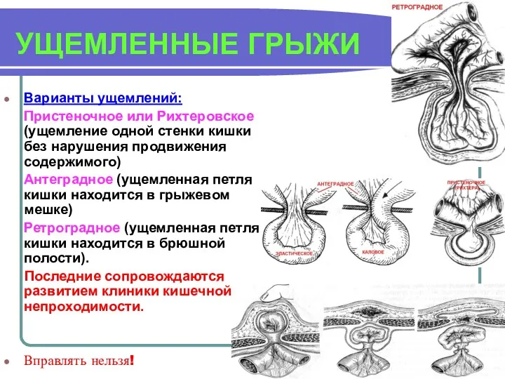 УЩЕМЛЕННЫЕ ГРЫЖИ Варианты ущемлений: Пристеночное или Рихтеровское (ущемление одной стенки кишки