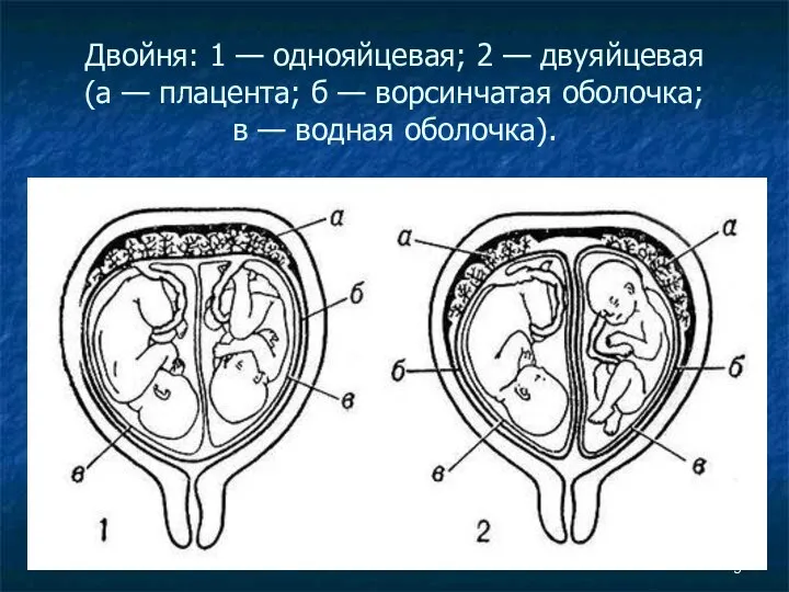 Двойня: 1 — однояйцевая; 2 — двуяйцевая (а — плацента; б