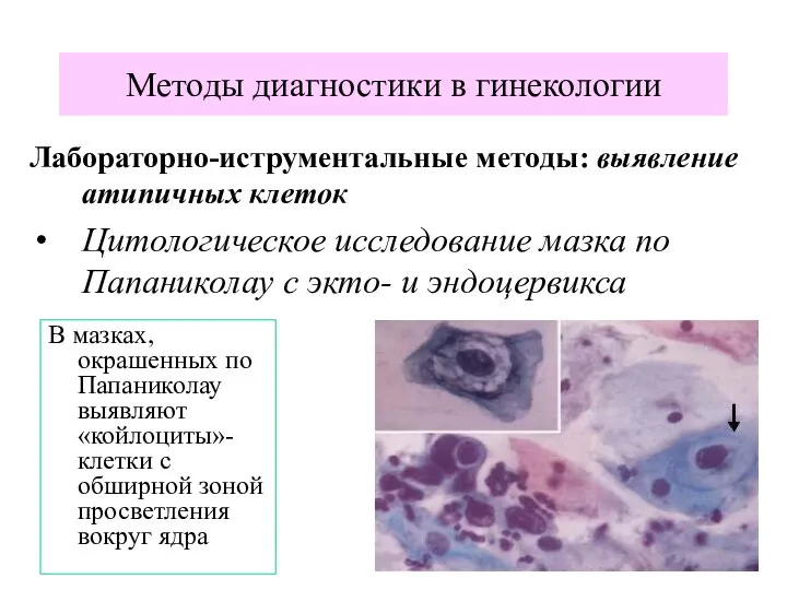 Лабораторно-иструментальные методы: выявление атипичных клеток Цитологическое исследование мазка по Папаниколау с