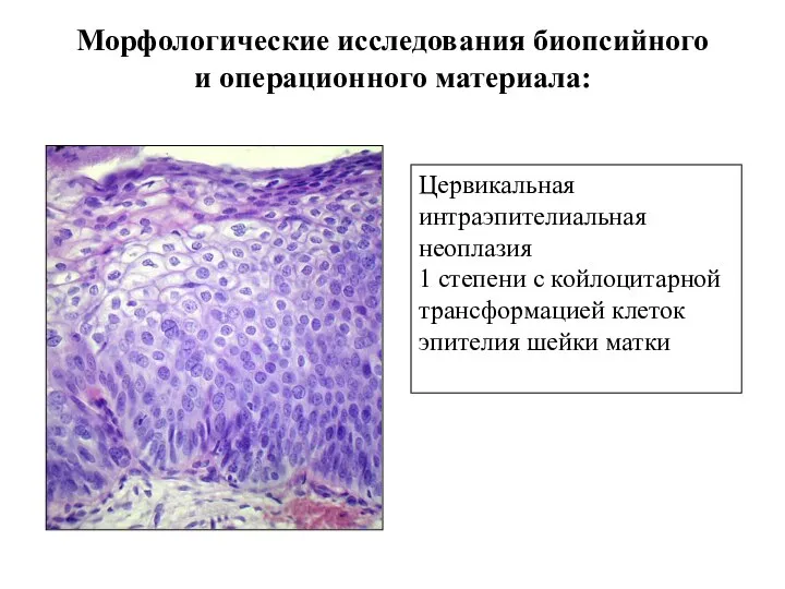 Морфологические исследования биопсийного и операционного материала: Цервикальная интраэпителиальная неоплазия 1 степени