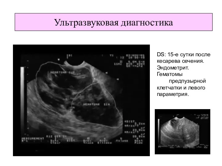 DS: 15-е сутки после кесарева сечения. Эндометрит. Гематомы предпузырной клетчатки и левого параметрия. Ультразвуковая диагностика