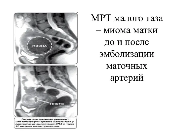 МРТ малого таза – миома матки до и после эмболизации маточных артерий