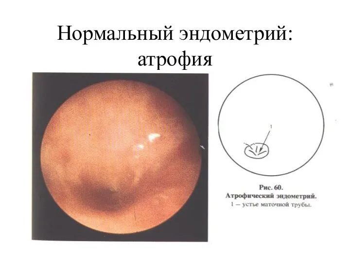 Нормальный эндометрий: атрофия