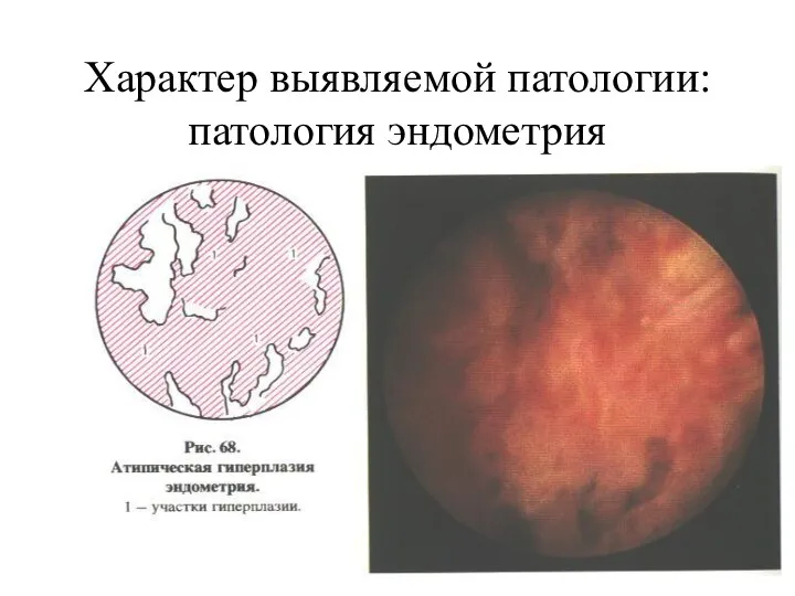 Характер выявляемой патологии: патология эндометрия