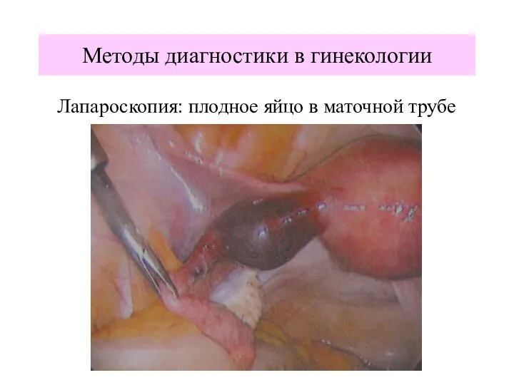 Методы диагностики в гинекологии Лапароскопия: плодное яйцо в маточной трубе