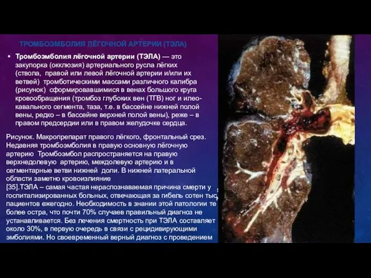 . яч м ТРОМБОЭМБОЛИЯ ЛЁГОЧНОЙ АРТЕРИИ (ТЭЛА) Тромбоэмболия лёгочной артерии (ТЭЛА)