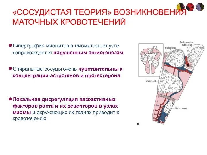 «СОСУДИСТАЯ ТЕОРИЯ» ВОЗНИКНОВЕНИЯ МАТОЧНЫХ КРОВОТЕЧЕНИЙ Гипертрофия миоцитов в миоматозном узле сопровождается