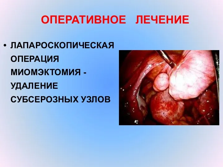 ОПЕРАТИВНОЕ ЛЕЧЕНИЕ ЛАПАРОСКОПИЧЕСКАЯ ОПЕРАЦИЯ МИОМЭКТОМИЯ - УДАЛЕНИЕ СУБСЕРОЗНЫХ УЗЛОВ