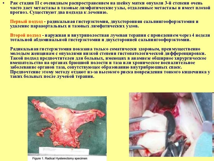 Рак стадии II с очевидным распространением на шейку матки опухоли 3-й