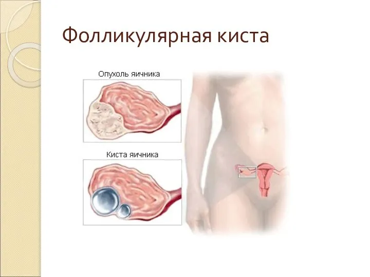 Фолликулярная киста