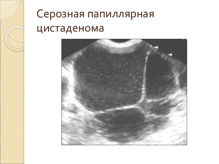 Серозная папиллярная цистаденома