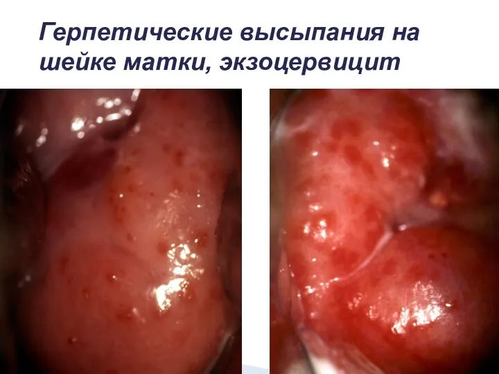 Герпетические высыпания на шейке матки, экзоцервицит