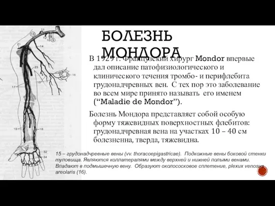 БОЛЕЗНЬ МОНДОРА В 1929 г. Французский хирург Mondor впервые дал описание