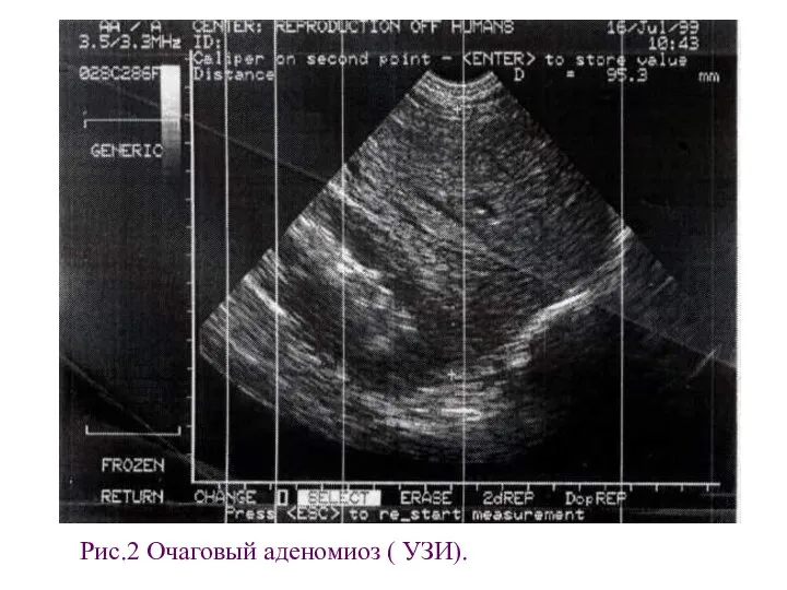 Рис.2 Очаговый аденомиоз ( УЗИ).