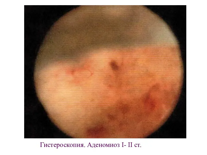Гистероскопия. Аденомиоз I- II ст.