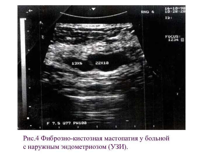 Рис.4 Фиброзно-кистозная мастопатия у больной с наружным эндометриозом (УЗИ).