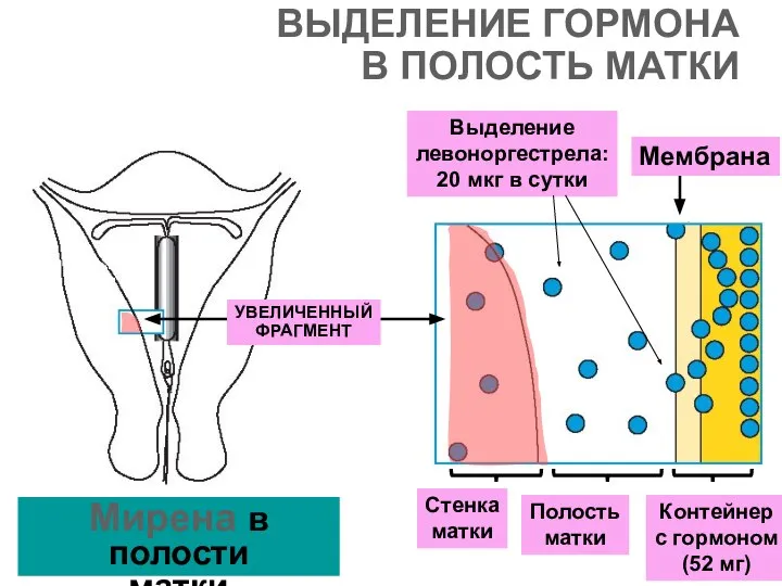 ВЫДЕЛЕНИЕ ГОРМОНА В ПОЛОСТЬ МАТКИ УВЕЛИЧЕННЫЙ ФРАГМЕНТ Мирена в полости матки