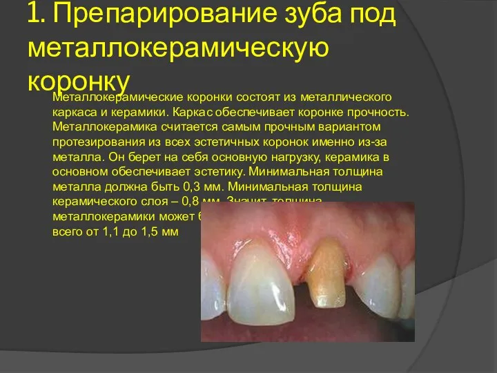 1. Препарирование зуба под металлокерамическую коронку Металлокерамические коронки состоят из металлического