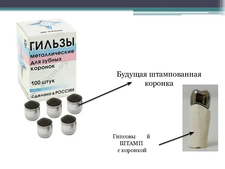 Будущая штампованная коронка Гипсовы й ШТАМП с коронкой