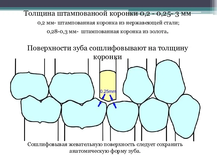 Толщина штампованоой коронки 0,2 - 0,25- 3 мм 0,2 мм- штампованная