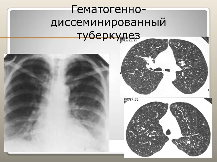 Гематогенно-диссеминированный туберкулез