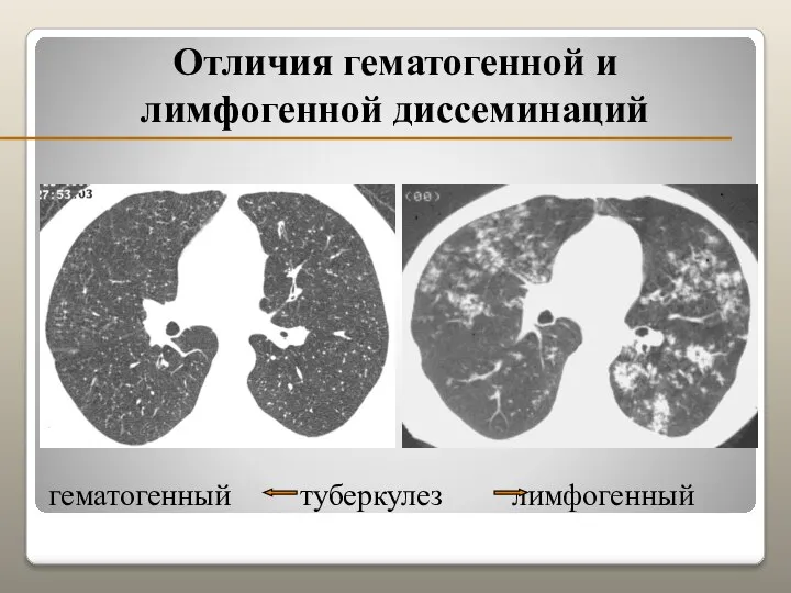 Отличия гематогенной и лимфогенной диссеминаций гематогенный туберкулез лимфогенный