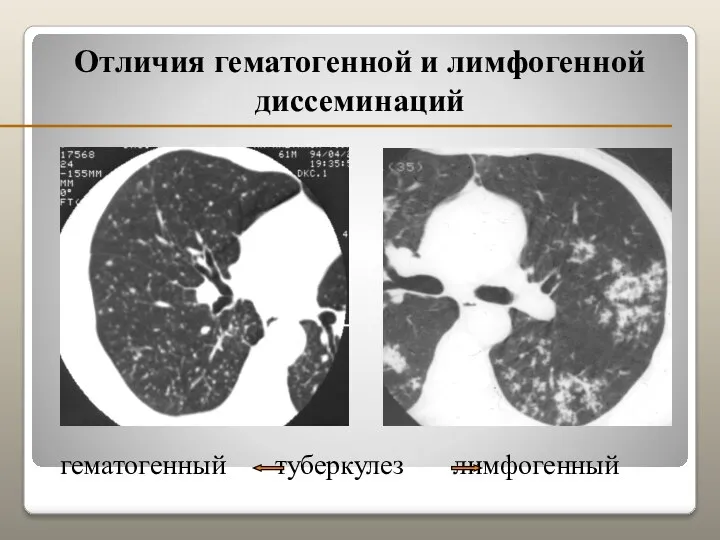 Отличия гематогенной и лимфогенной диссеминаций гематогенный туберкулез лимфогенный