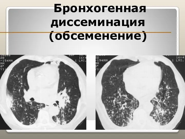 Бронхогенная диссеминация (обсеменение)