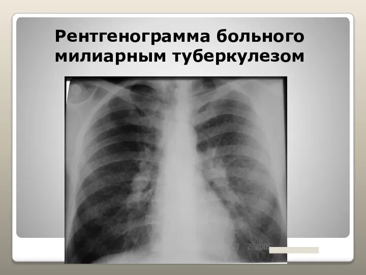 Рентгенограмма больного милиарным туберкулезом
