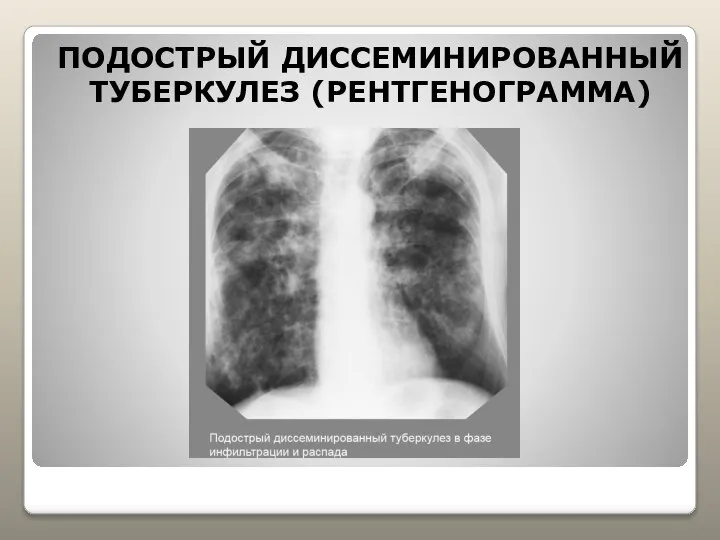 ПОДОСТРЫЙ ДИССЕМИНИРОВАННЫЙ ТУБЕРКУЛЕЗ (РЕНТГЕНОГРАММА)