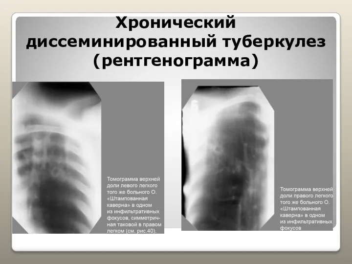 Хронический диссеминированный туберкулез (рентгенограмма)