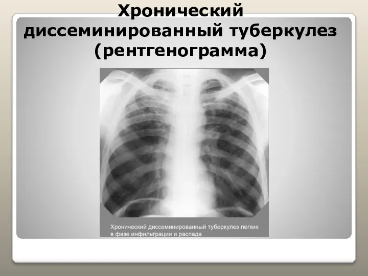 Хронический диссеминированный туберкулез (рентгенограмма)