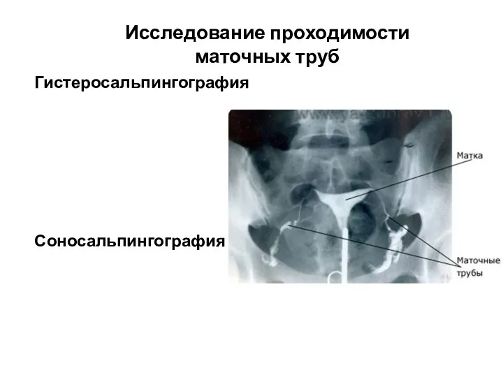 Исследование проходимости маточных труб Гистеросальпингография Соносальпингография