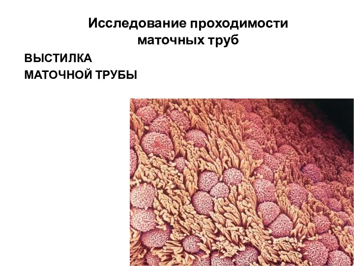 Исследование проходимости маточных труб ВЫСТИЛКА МАТОЧНОЙ ТРУБЫ