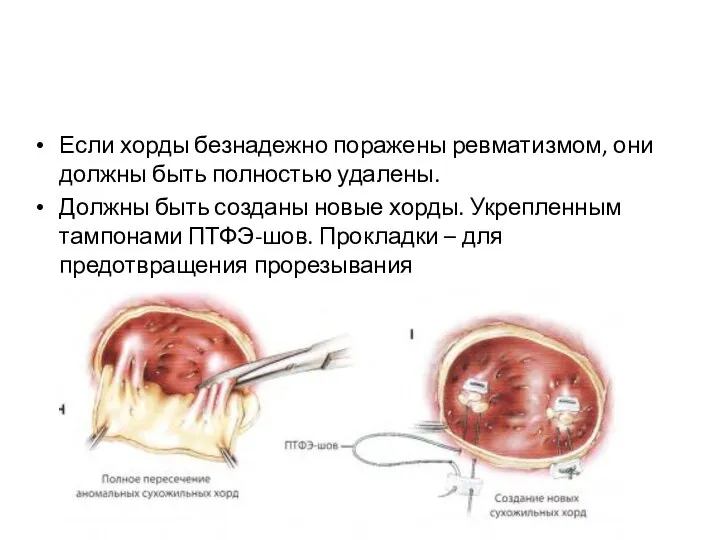 Если хорды безнадежно поражены ревматизмом, они должны быть полностью удалены. Должны