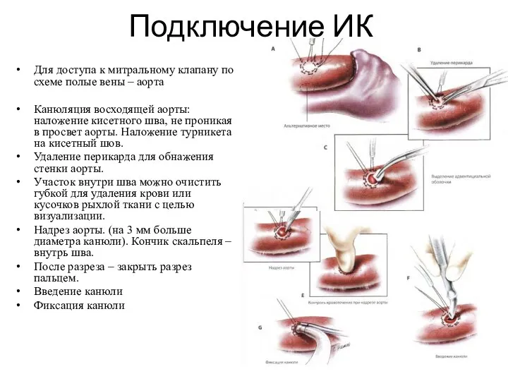 Подключение ИК Для доступа к митральному клапану по схеме полые вены