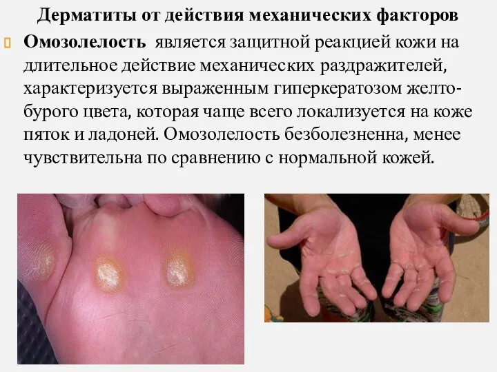 Дерматиты от действия механических факторов Омозолелость является защитной реакцией кожи на