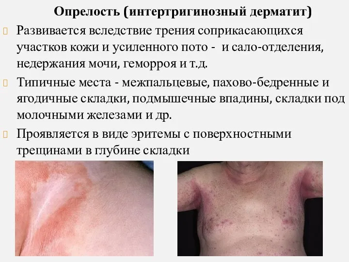 Опрелость (интертригинозный дерматит) Развивается вследствие трения соприкасающихся участков кожи и усиленного