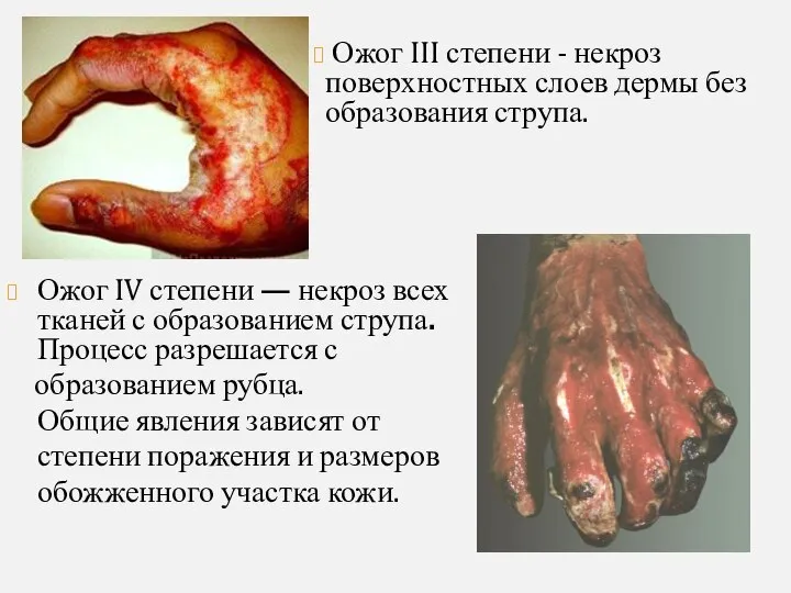 Ожог III степени - некроз поверхностных слоев дермы без образования струпа.