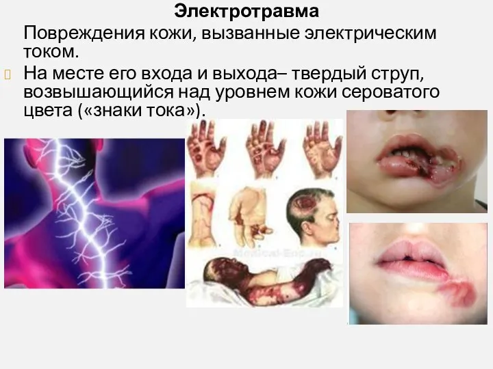 Электротравма Повреждения кожи, вызванные электрическим током. На месте его входа и