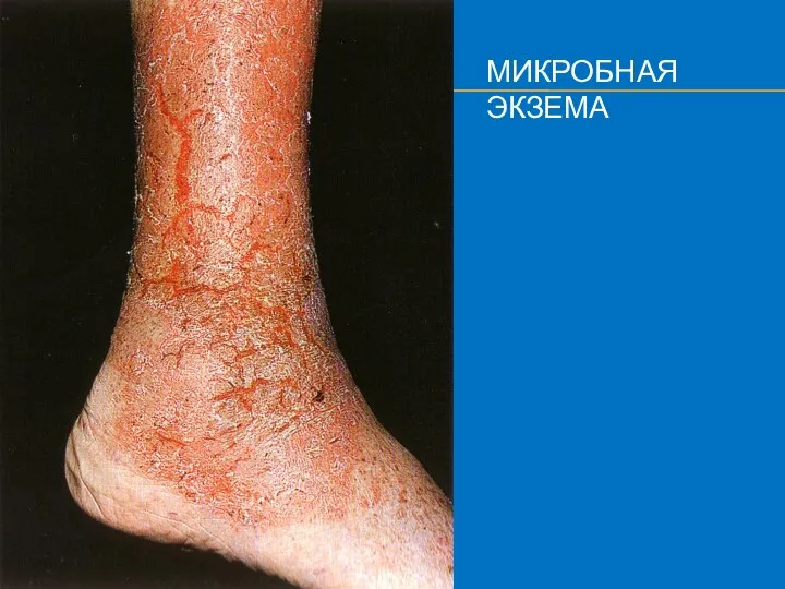 МИКРОБНАЯ ЭКЗЕМА