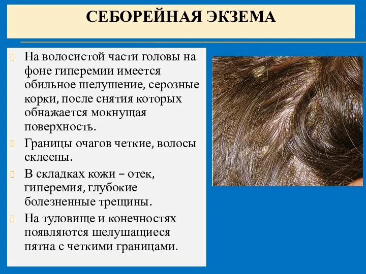 СЕБОРЕЙНАЯ ЭКЗЕМА На волосистой части головы на фоне гиперемии имеется обильное