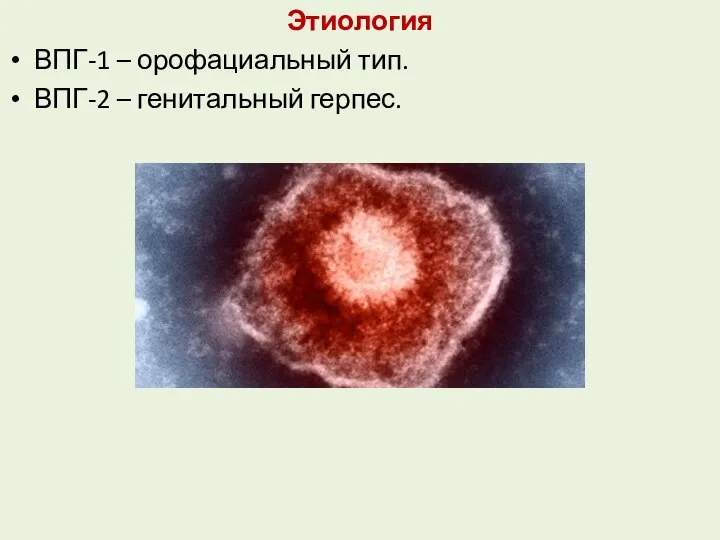 Этиология ВПГ-1 – орофациальный тип. ВПГ-2 – генитальный герпес.