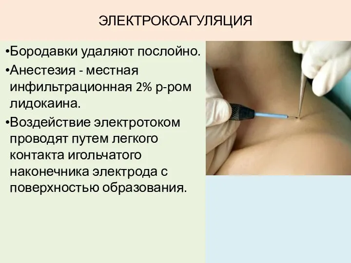 ЭЛЕКТРОКОАГУЛЯЦИЯ Бородавки удаляют послойно. Анестезия - местная инфильтрационная 2% р-ром лидокаина.